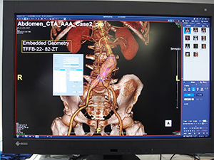 ステントのサイズを計測できるバーチャルステント機能