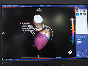 CT画像とSPECT画像のフュージョン/テリトリ解析