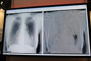 胸部X線読影診断ソリューション「ClearRead+ Compare」の臨床画像。左が骨組織の透過処理画像，右が差分し経時的な変化を強調した画像。