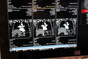 レジストレーションモジュール「Blackford Analysis」では，検査時期の異なる画像やマルチモダリティ画像を高い精度で位置合わせできる。