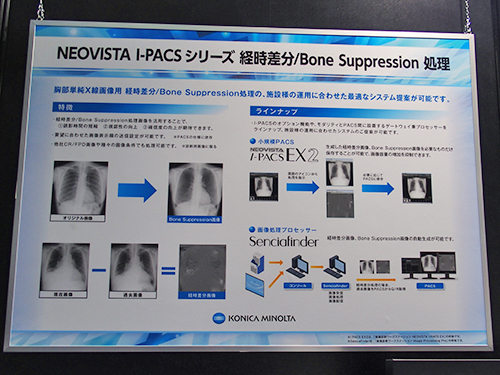 胸部画像の診断精度を高める“経時差分/Bone Suppression処理”