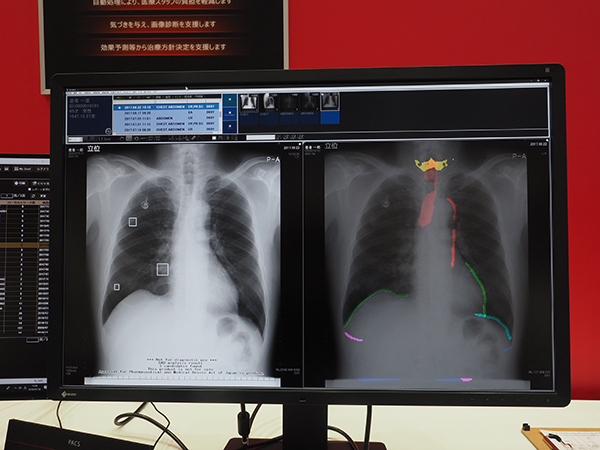 開発が進められている胸部単純X線画像AIソフトウエア（写真左が胸部結節検出，右が肺野異常検知）（W.I.P.）