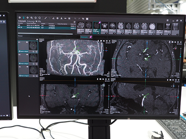 “Aneurysm”は脳MR画像から動脈瘤候補を検出