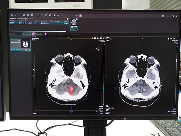 頭部単純CT画像上で出血部位を強調表示する“Hemorrhage analysis”