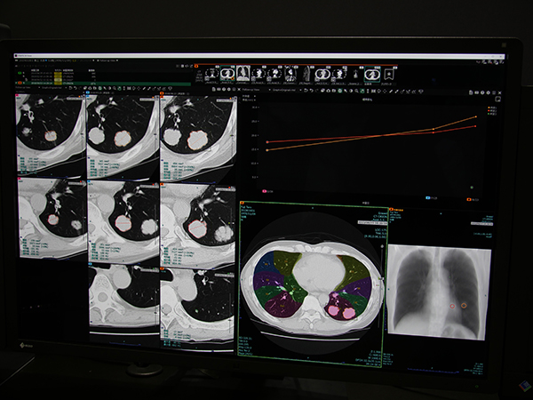 胸部CT画像での肺結節の自動検出，自動計測，経時評価を紹介