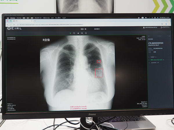 「EIRL Chest Screening」異常陰影候補の検出結果表示