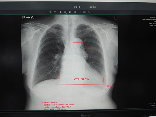 自動計測により医師間の計測誤差を抑制できる。