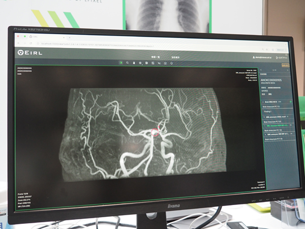 アルゴリズムの見直しにより偽陽性が改善した「EIRL Brain Aneurysm」