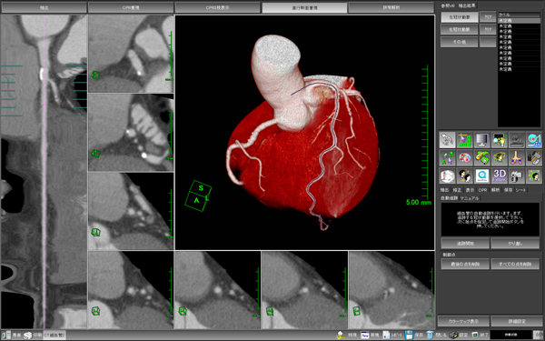 使い易さを追求した「新・冠動脈解析ソフトウェア」