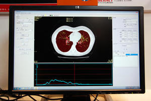 CT肺気腫計測ソフトウエア「LungVision」