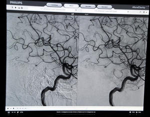 70％以上の線量を削減して撮影されたAllura Clarityの画像（右），左が従来の画像