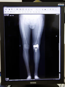 スロットラジオグラフィで撮影した人工骨の埋設手術後の確認画像