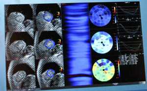 MRIのタギング画像から心筋の収縮を定量化するMRストレイン解析（WIP）