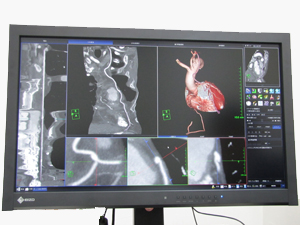 “新・CT細血管解析”の冠動脈バイパスグラフト解析機能