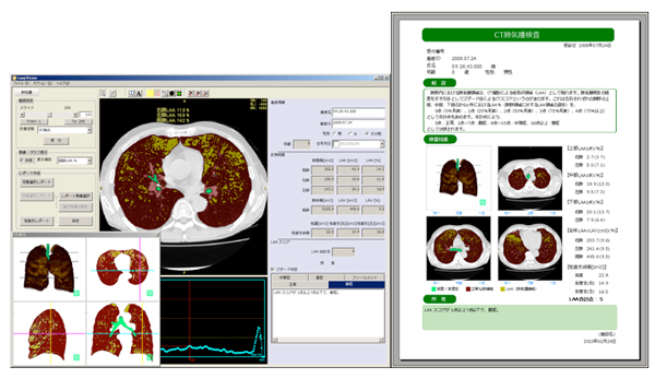 肺気腫計測ソフト『LungVision2』（ラングビジョン2）