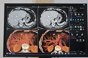 肺野の元画像（左）と“iIR Σ”（W.I.P.）適用画像（右）