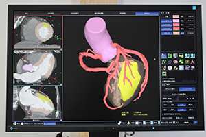 冠動脈の支配領域の割合を算出する心筋領域分割機能