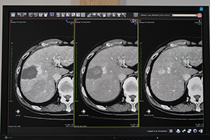 RFAの前後の画像を重ね合わせることで，腫瘍が焼灼範囲に収まっているかを一目で確認できる（中央）。