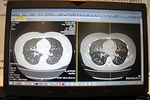3D MIPスラブ画像
