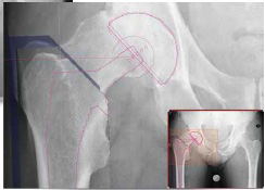 [OrthoView] 整形外科用デジタルプランニングソフト