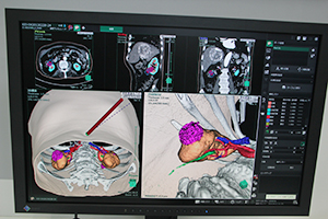 SYNAPSE VINCENTの新しいソフトウエアを紹介。泌尿器科領域での腎臓の腹腔鏡下手術シミュレーション