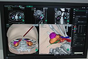 SYNAPSE VINCENTの腎臓解析・計測と鏡視下シミュレータ