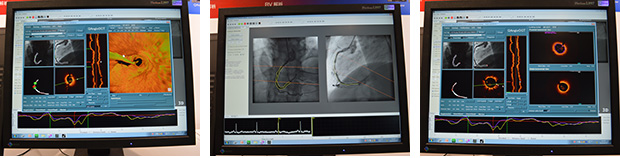 正確な心血管解析を行うQAngioXA 3D & QAngio OCTの操作画面