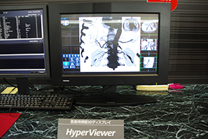 裸眼3DディスプレイのHyperViewerは術前シミュレーションにも有用