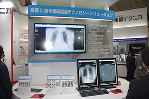 胸部X線骨組織透過テクノロジーソリューション