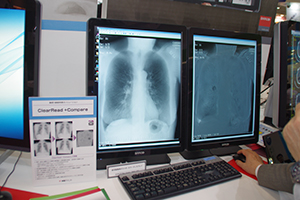 胸部X線経時差分ソリューション「ClearRead ＋compare」