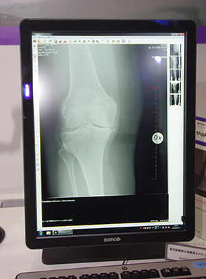 整形外科デジタルプランニングツール「Ortho Planner Pro」ビューワ画面
