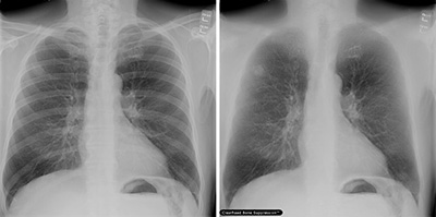 「胸部X線骨組織透過テクノロジー」コーナー