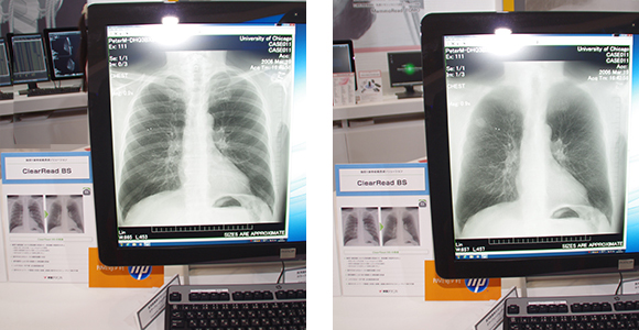 骨組織を透過させ観察しやすい胸部X線骨組織透過ソリューションClearRead BS（左：元画像，右：処理後の画像）