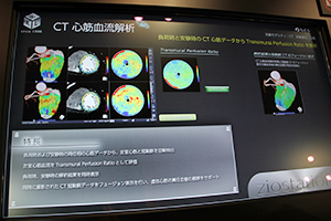 ziostation2の新機能，CT心筋血流解析。心臓CTのデータから左室心筋と冠動脈を自動抽出し評価可能