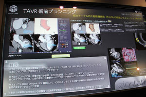 経カテーテル的大動脈弁留置術の術前シミュレーションを行うTAVR術前プランニング