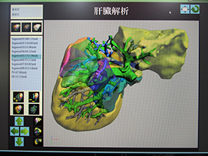肝切除の際などに患者説明や手技支援に利用できる“3Dレポーティング”