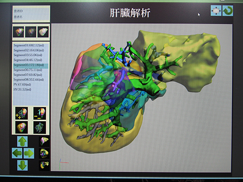 患者説明や術中の確認に役立つ“3D PDFレポート”