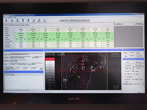 治療計画のMU値を瞬時にチェックできるIMSure QA