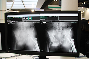 散乱線推定技術でグリッドレス撮影を可能にする“VirtualGrid”は骨盤領域にも対応が拡大