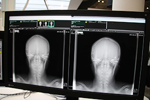 一般撮影のトモシンセシスは骨折や人工関節の経過観察などに有用