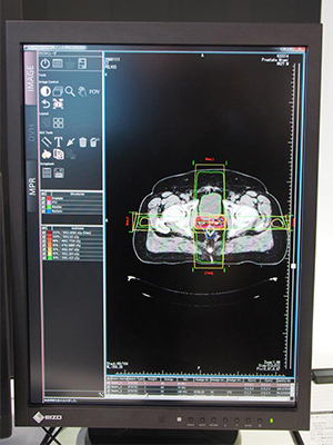 放射線治療の画像ビューワ「RT Image Viewer」