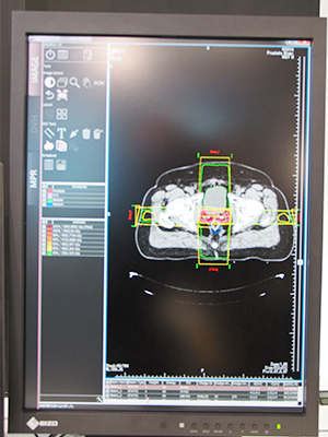 放射線治療専用画像ビューワの「RT Image Viewer」