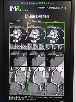 心電図同期を使用した低線量心臓検査の臨床画像