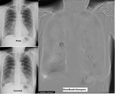 胸部X線骨組織透過テクノロジー