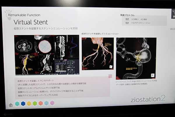 仮想ステントでのシミュレーションが可能な“Virtual Stent”