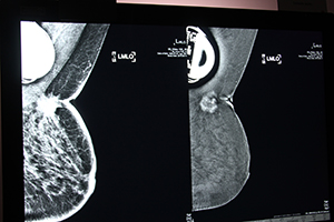 ペースメーカーを埋め込んでいる患者のi-view画像（右）