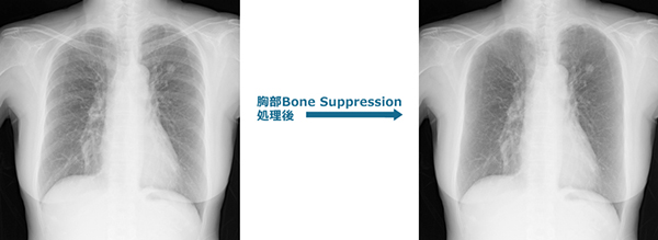 胸部Bone Suppression処理