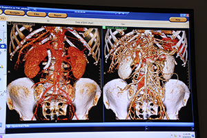 腹部CTA：通常画像（左）では血管抽出が困難だが，40keVの仮想単色X線画像（右）により明瞭な血管描出が可能となる。