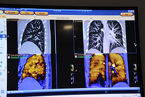 血栓の検出に有用な胸部CTパフュージョン画像も検査後に任意で作成できる。