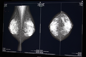 MicroDose mammography SIでは平均乳腺線量が0.5〜0.7mGy程度と，非常に低線量での撮影が可能